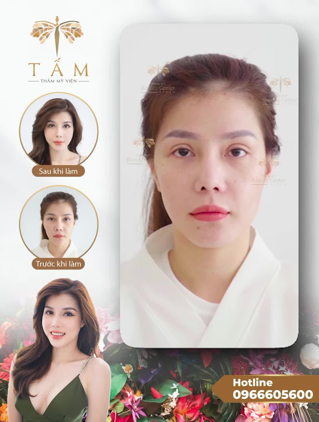 Tân trang nhan sắc cùng combo Filler bên Tấm