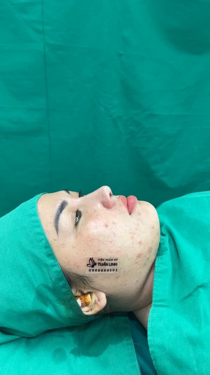 Case mũi Siêu cấu trúc sụn Surgiform vừa hoàn thành sau 90 phút!