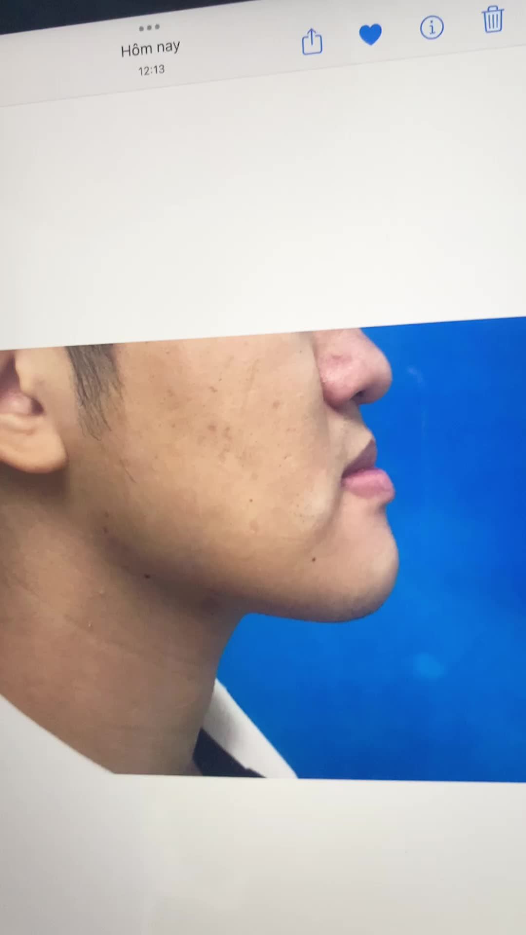 Kết quả chỉnh hàm móm ngay sau khi phẫu thuật Kangnam Hà Nội 190 Trường Chinh
