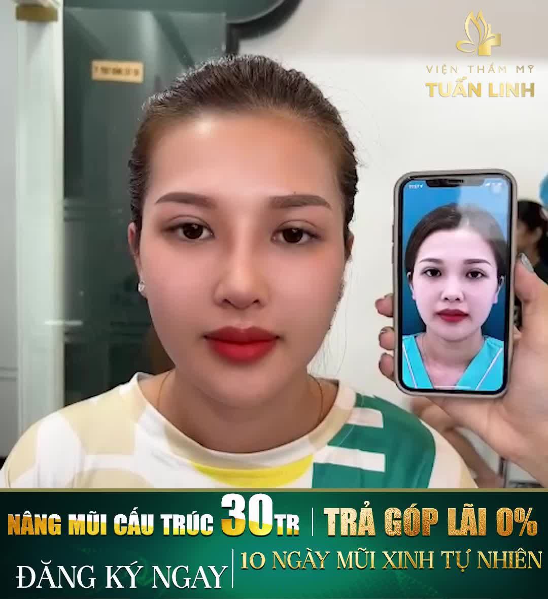 NÂNG MŨI CẤU TRÚC ANGEL LINE SIÊU ĐẸP - DẸP BỎ NỖI LO VỀ GIÀ!!!