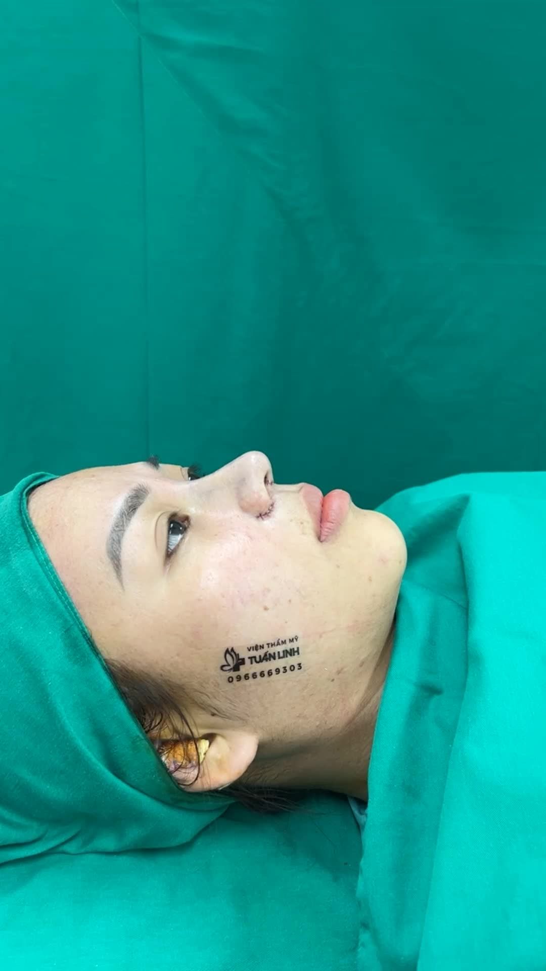 Nâng mũi cấu trúc + cắt cánh mũi cho bạn gái Bình Tân