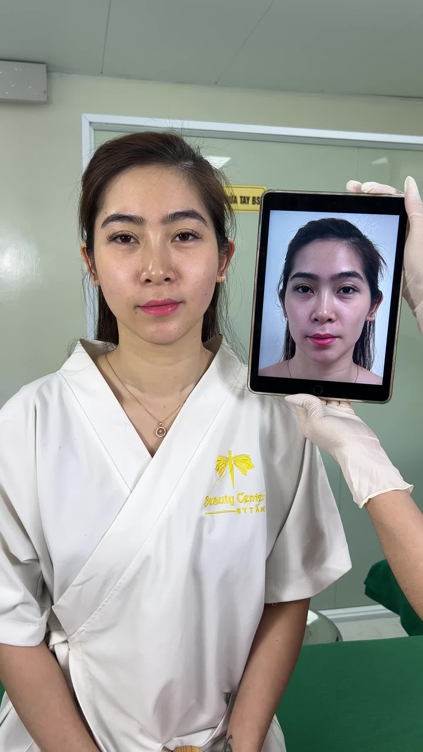 Cận cảnh ca filler má - thái dương tại TMV Tấm. Khuyết điểm má và thái dương hóp của bạn khách hàng được cải thiện rõ rệt.