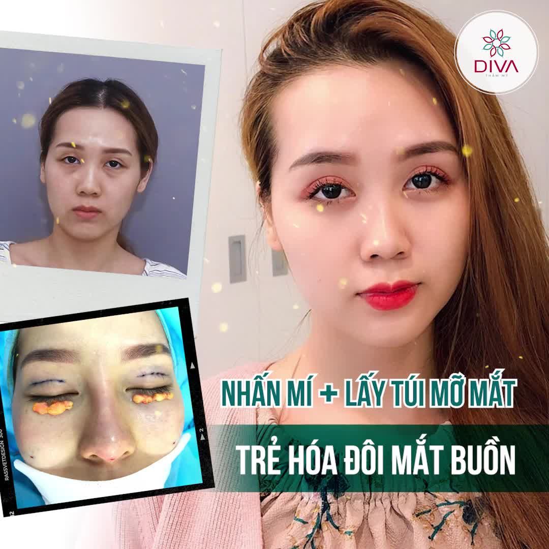 KẾT QUẢ SAU THẨM MỸ NHẤN MÍ + LẤY TÚI MỠ MÍ DƯỚI TRẺ HÓA ĐÔI MẮT BUỒN