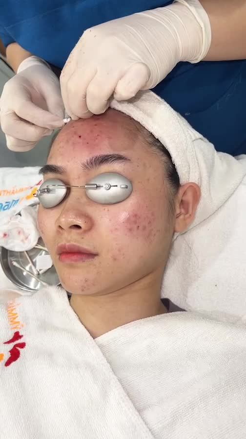 Quy trình điều trị mụn cực hiệu quả với công nghệ De-acne của BVTM Kangnam