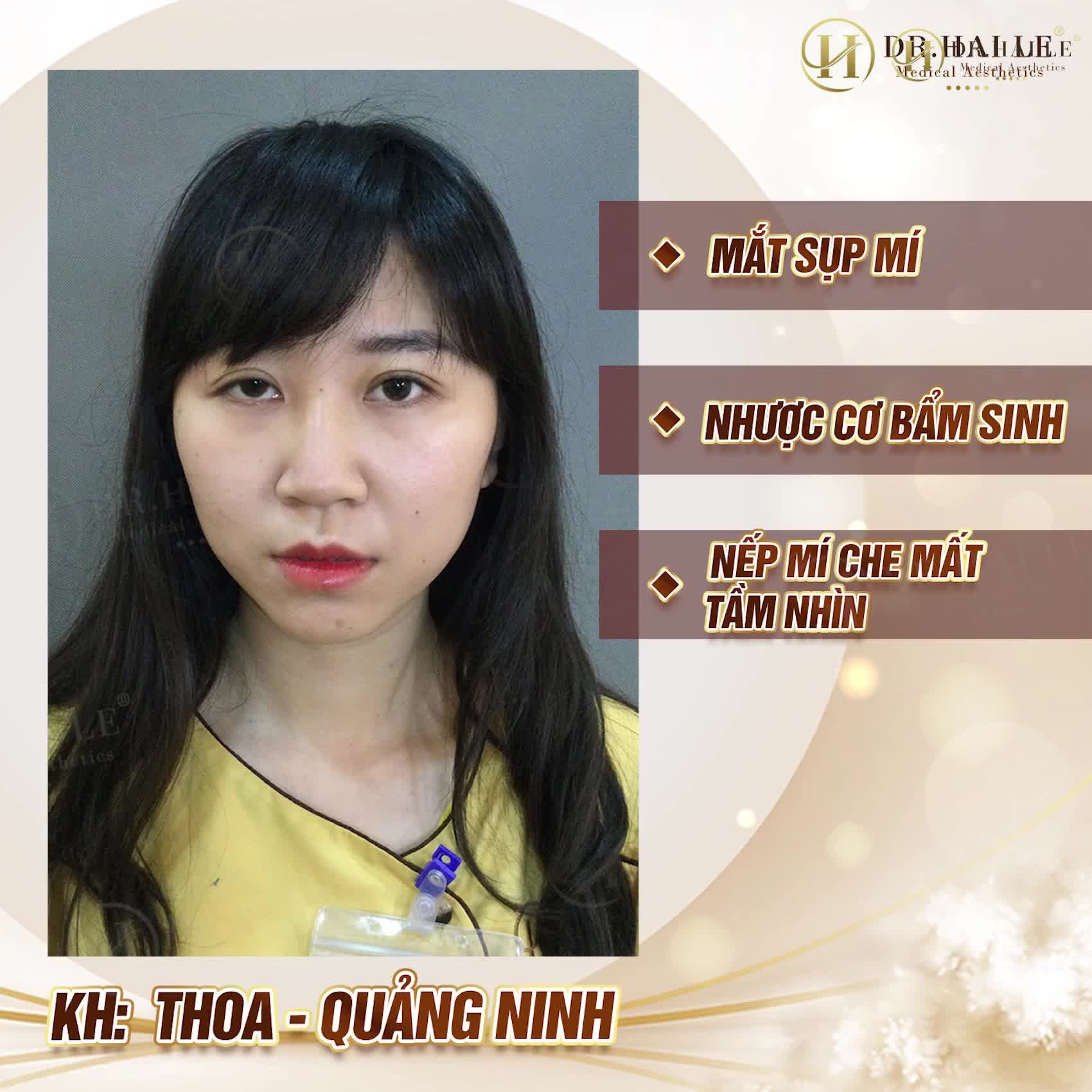 Cắt mí Dr.Hải Lê sau 7 ngày đẹp TỰ NHIÊN ai nhìn cũng ngỡ ngàng...