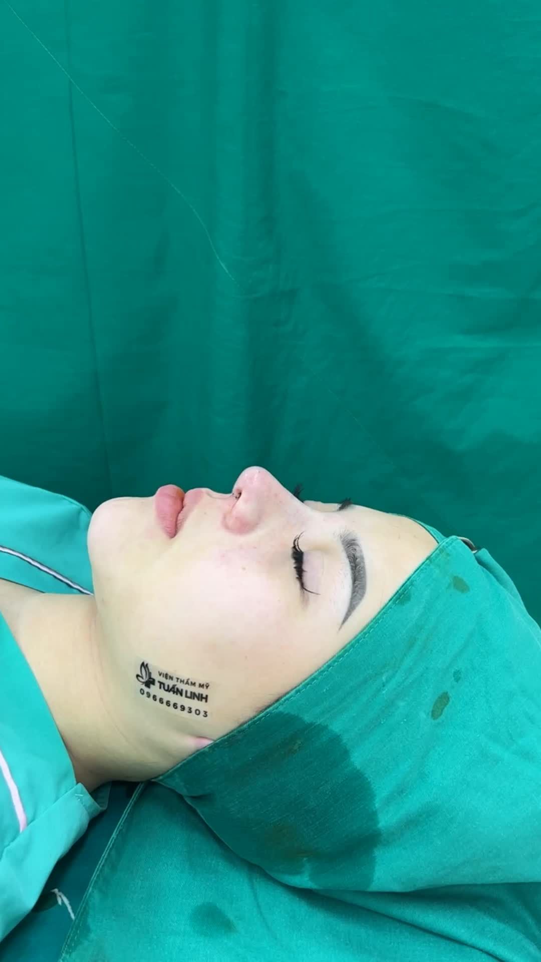 Hoàn thành case mũi cấu trúc (sửa lại) cho bạn gái đến từ Huế