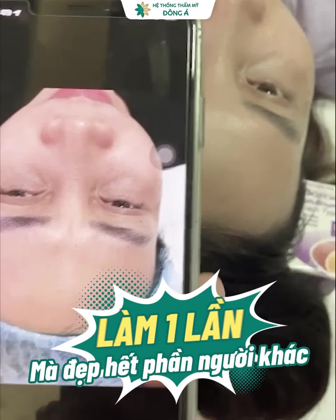 CẢNH BÁO CÂN NHẮC TRƯỚC KHI TIÊM BOTOX