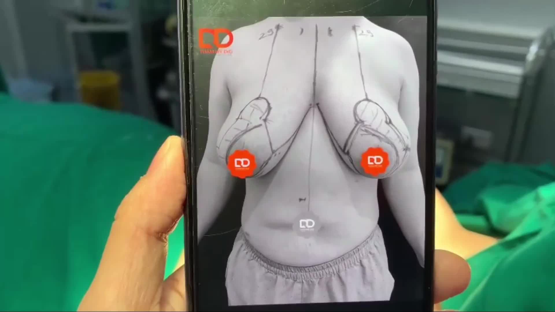 KẾT QUẢ CA PHẪU THUẬT THU NGỰC PHÌ ĐẠI SAU 60 PHÚT