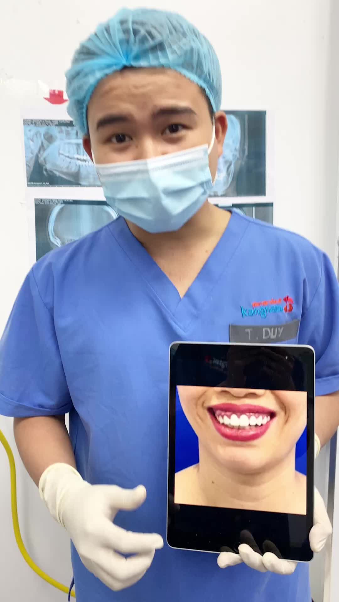 Kết quả ngay sau khi phẫu thuật chỉnh hàm hô 2 hàm tại Kangnam Hà Nội 190 Trường Chinh