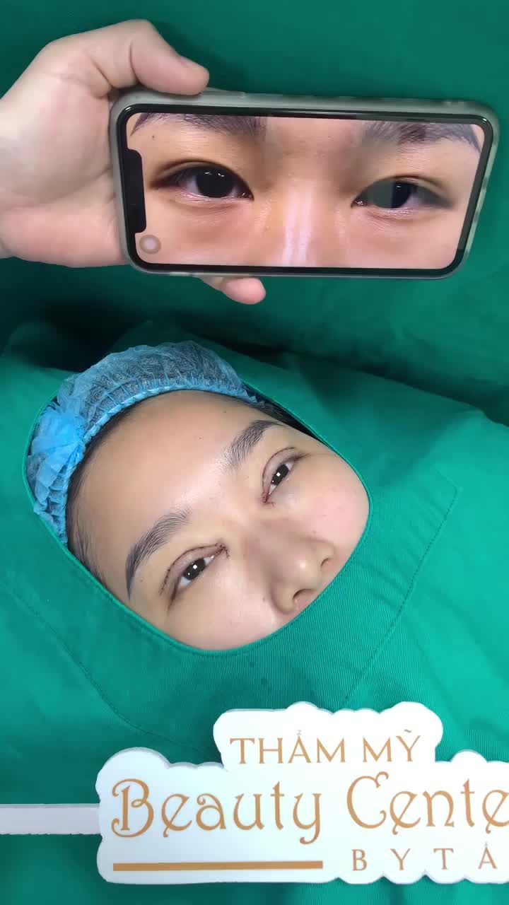 Chiêm ngưỡng sự thay đổi trước và ngay sau thực hiện Combo Cắt mí mở góc trong tại TMV Tấm.