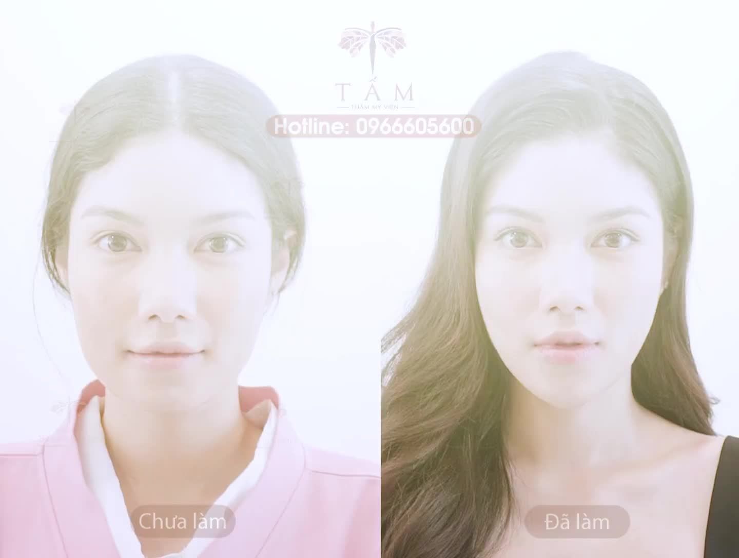 FILLER MÁ - CẰM -THÁI DƯƠNG - Combo filler đẹp  tựa nàng thơ chỉ sau 30 phút duy nhất tại Tấm