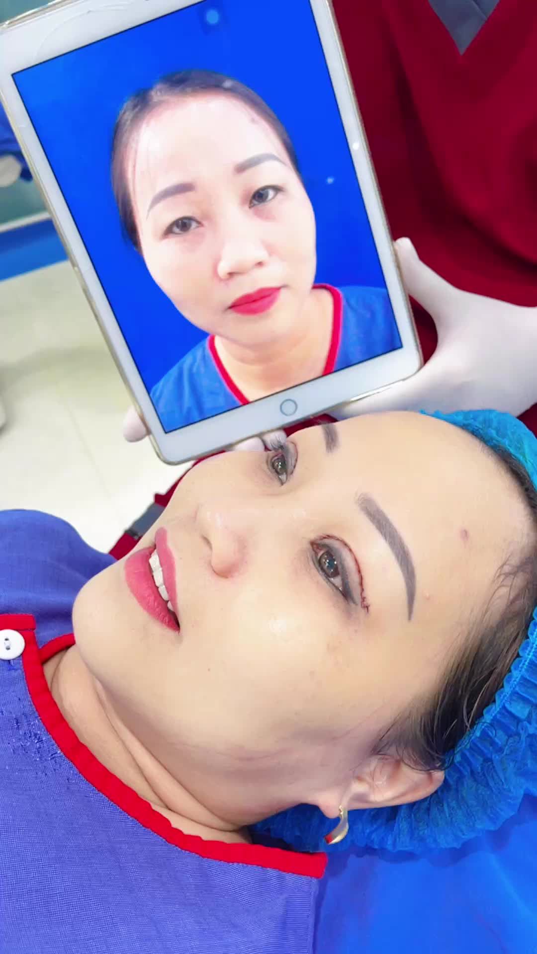 Cắt mí không đau chút nào!