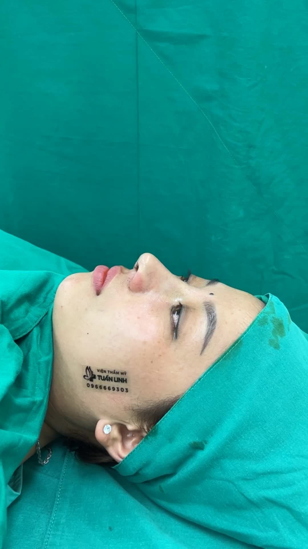 Case Nâng mũi cấu trúc sụn Surgiform cho bạn gái đến từ Long An.