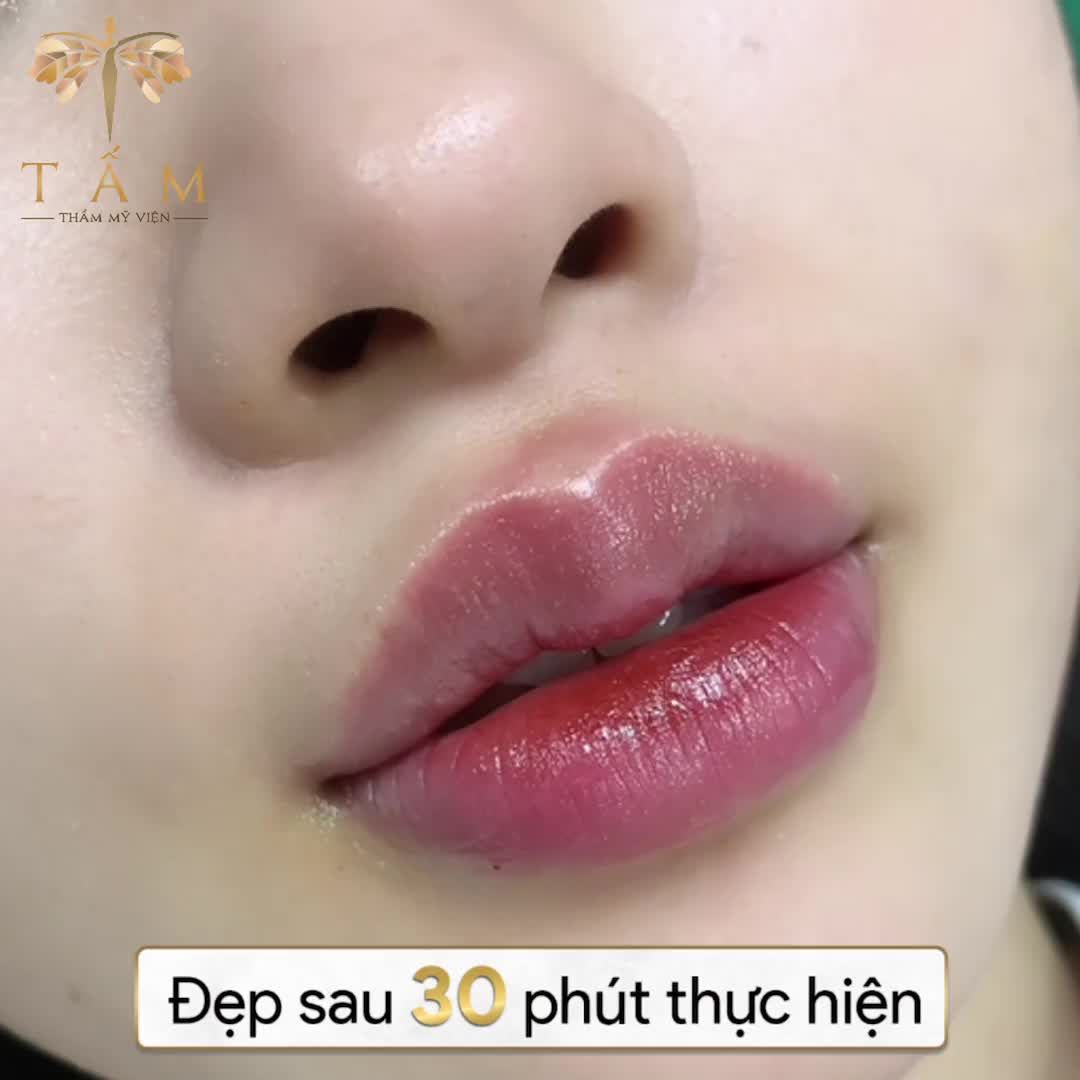 HÃY ĐẾN TẤM ĐỂ SỞ HỮU ĐÔI MÔI SEXY, QUYẾN RŨ VỚI CÔNG NGHỆ TẠO HÌNH MÔI ĐỈNH CAO