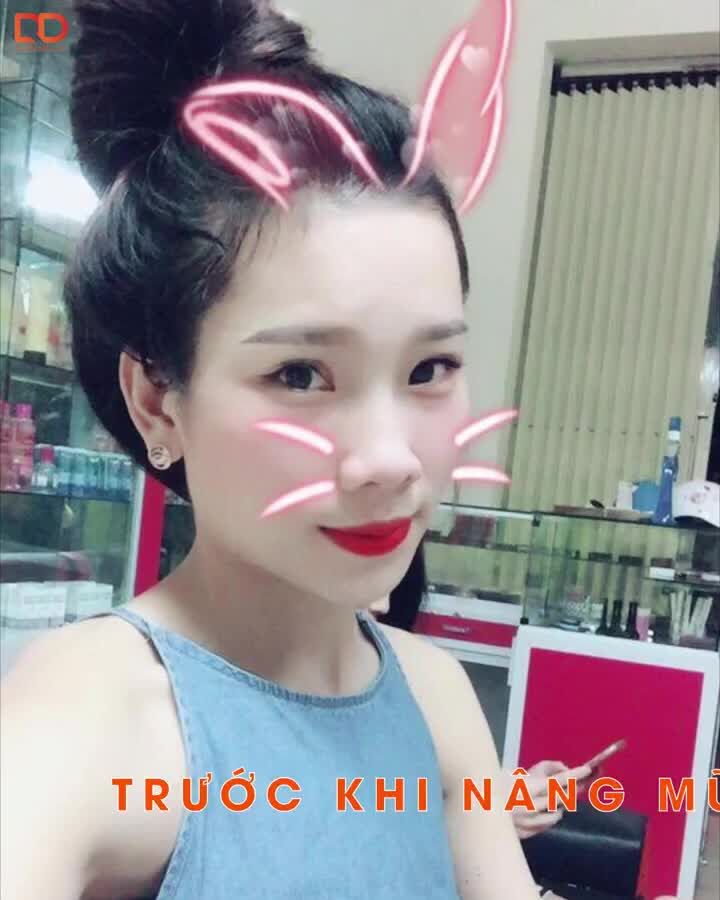 TÔI ĐÃ THAY ĐỔI NHƯ THẾ NÀO SAU PHẪU THUẬT NÂNG MŨI