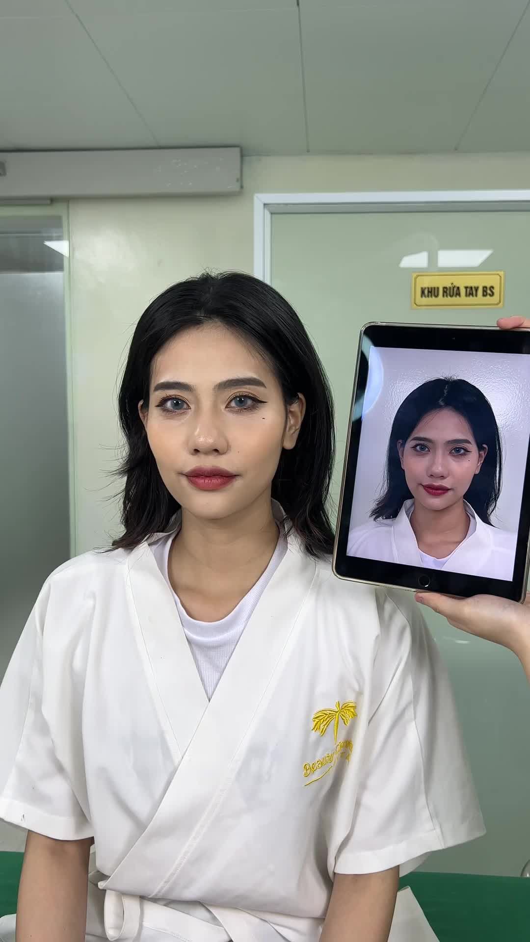 Cận cảnh ca filler Thái dương cho bạn tiktoker Châm Sứa. Mời cả nhà cùng theo dõi