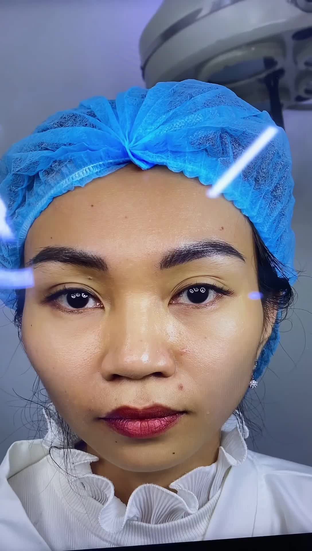 Kết quả nâng mũi Surgiform cho chị khách.  Tình trạng mũi ban đầu có sống thấp, đầu mũi tròn bẹt và cánh mũi bè.