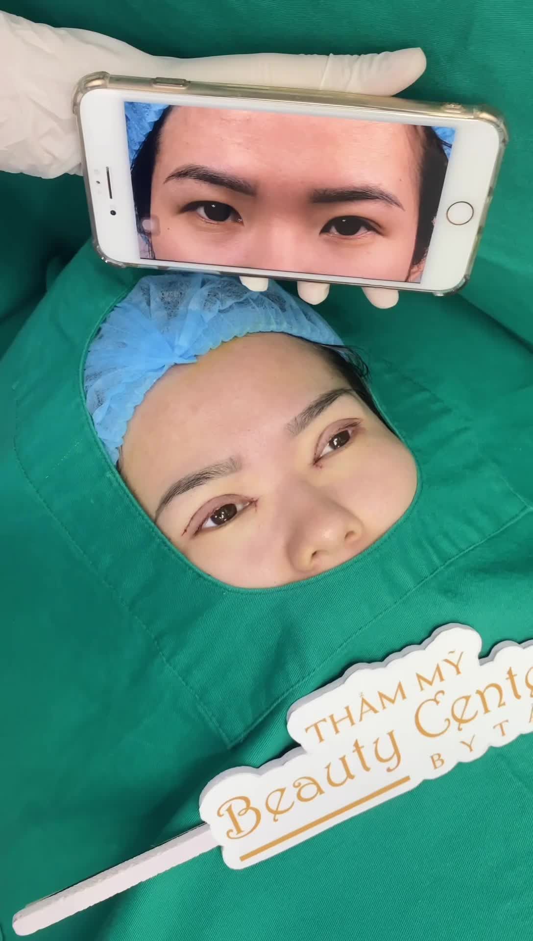 Cách nhanh và hiệu quả nhất để cải thiện đôi mắt buồn mí sụp là qua TMV Tấm cắt mí và mở góc trong.