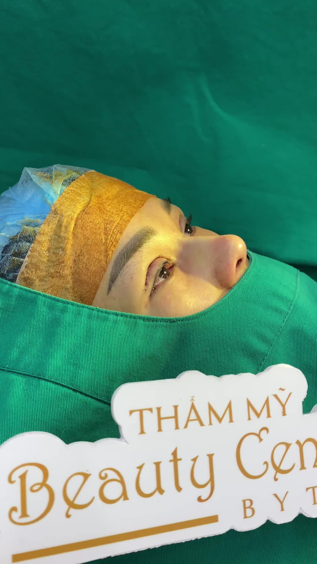 Kết quả combo Perfect Eyes + nâng mũi Surgiform
