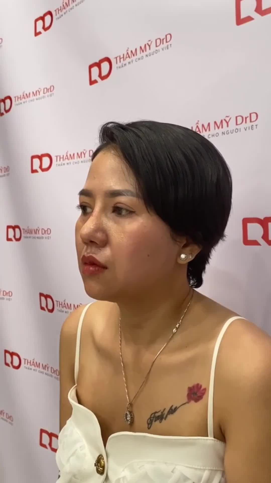 Chúng ta lại gặp lại nhau trong 1 ca phẫu thuật Nâng mũi Perfect Dform sau 12 ngày phẫu thuật.