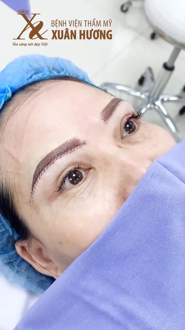 CHỊ RẤT ƯNG Ý! RẤT ĐẸP - CHỊ KHÁCH HÀNG PHẢN HỒI NGAY SAU KHI VỪA THỰC HIỆN NÂNG CUNG MÀY TẠI BVTM XUÂN HƯƠNG