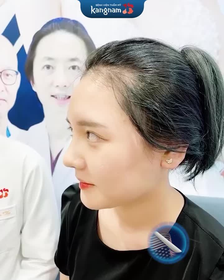 Mũi thấp + xương mũi gồ làm sao khắc phục