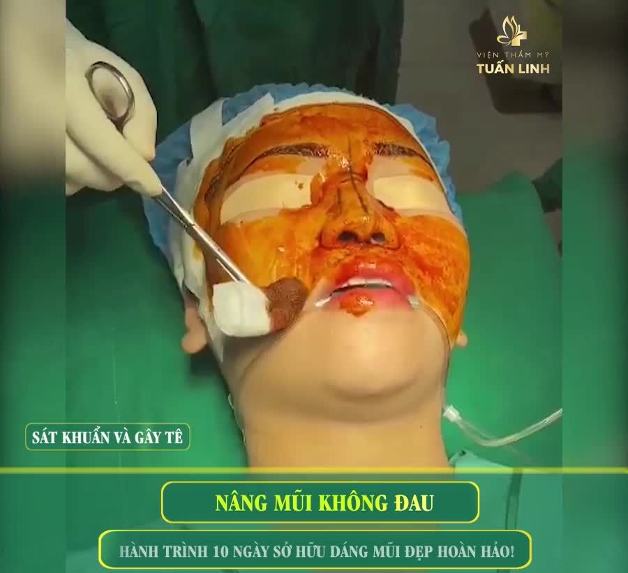 NÂNG MŨI KHÔNG ĐAU  VÀ HÀNH TRÌNH 10 NGÀY SỞ HỮU DÁNG MŨI XINH