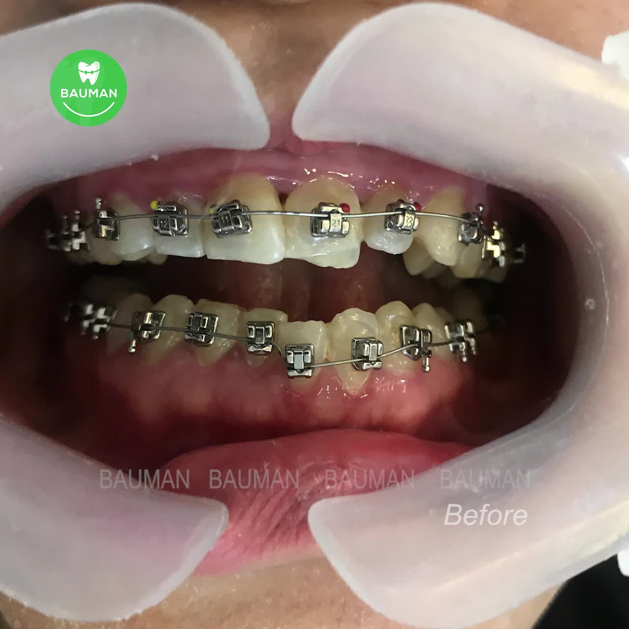 Xem thêm 76 video Niềng răng của bác sĩ Nha khoa Bauman Clinic