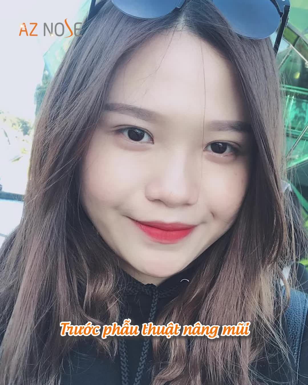 Cô chủ nhỏ xinh đẹp sau 1 năm nâng mũi cấu trúc