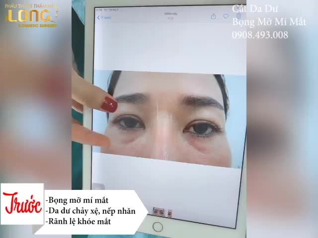 KHÁCH HÀNG SAU 30 PHÚT LẤY BỌNG MỠ MÍ DƯỚI