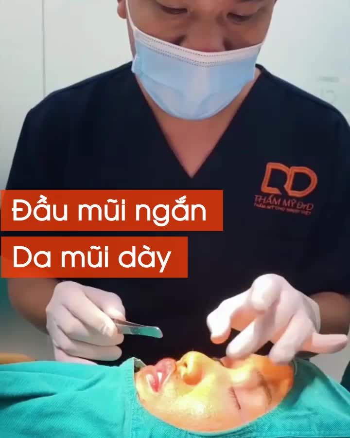 ĐỈNH KOUT NÂNG MŨI PERFECT DFORM - CÂN MỌI LOẠI MŨI, KỂ CẢ KHI TRỤC MŨI LỆCH