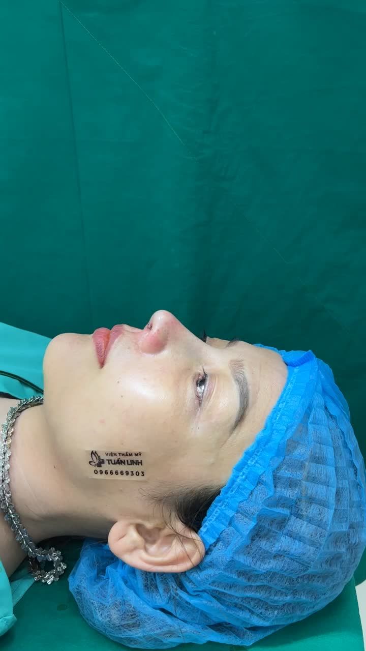 Case Nâng mũi cấu trúc sụn #Surgiform rút chỉ hoàn thành sau 90 phút