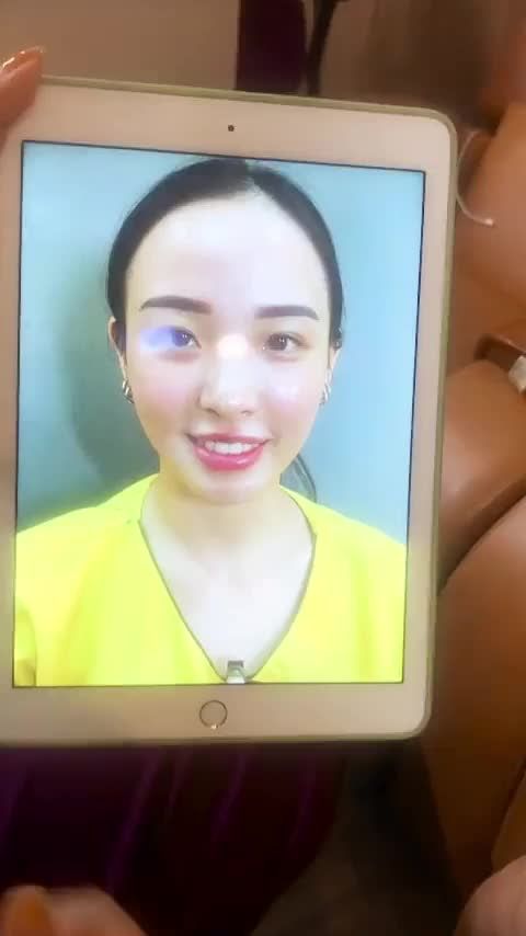 Cô nàng đến từ Singapore xinh đẹp rạng rỡ chỉ sau 7 ngày cắt mí tại Dr.Hải Lê