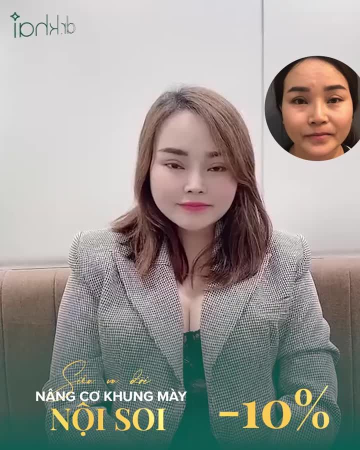 SOI NGAY KẾT QUẢ NÂNG CƠ KHUNG CHÂN MÀY NỘI SOI SAU 3 THÁNG