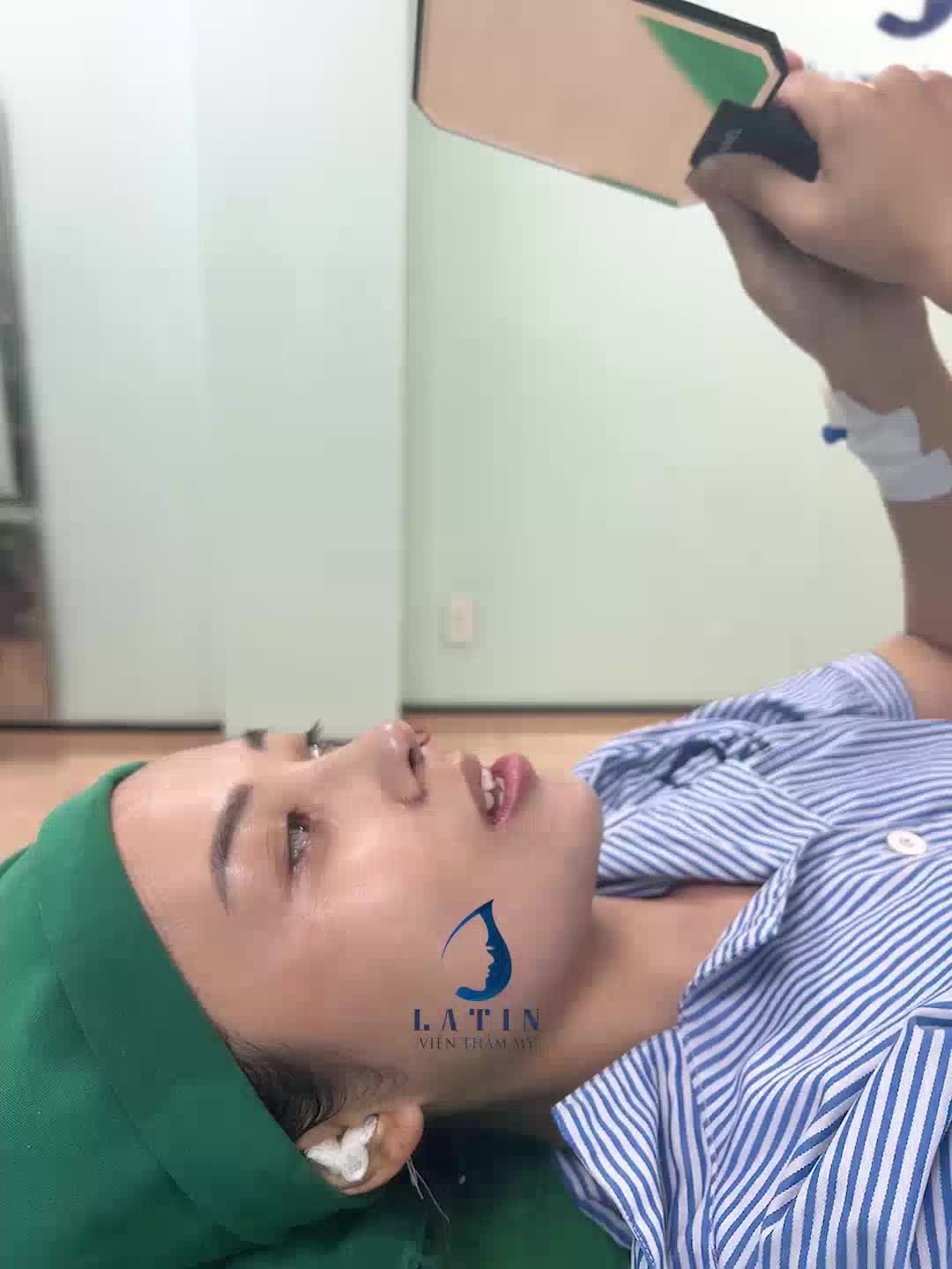 Combo mũi + cằm vừa hoàn thành tại Latin