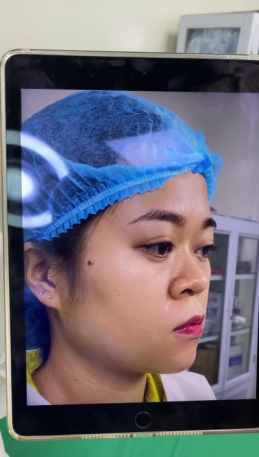 Kết quả ngay sau khi hoàn thành ca nâng mũi Surgiform cho khách hàng