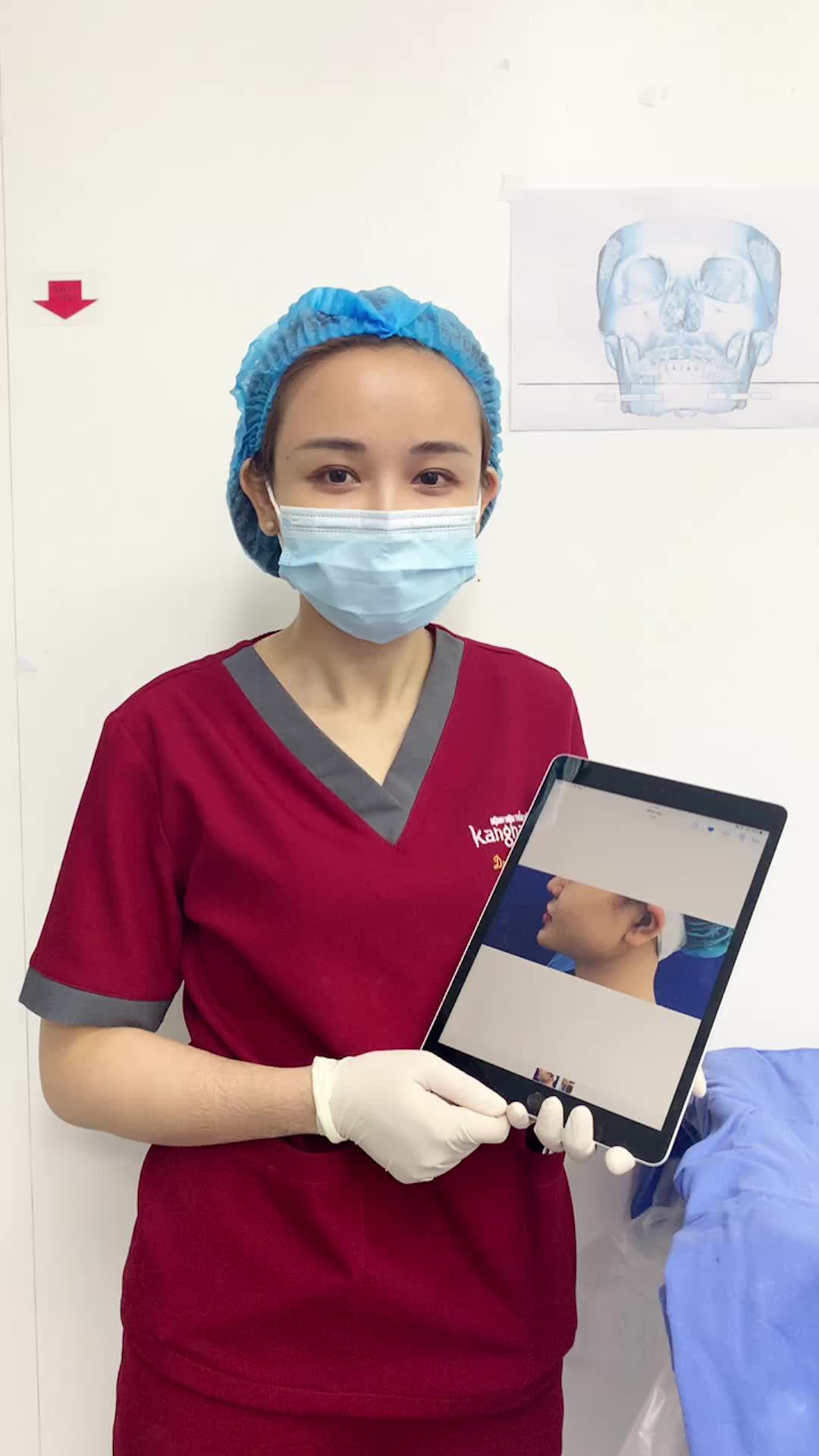 Kết quả ngay sau phẫu thuật Gọt hàm V-Line 3D