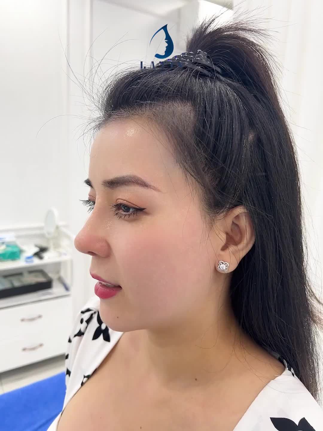 Mũi cấu trúc sau 13 ngày