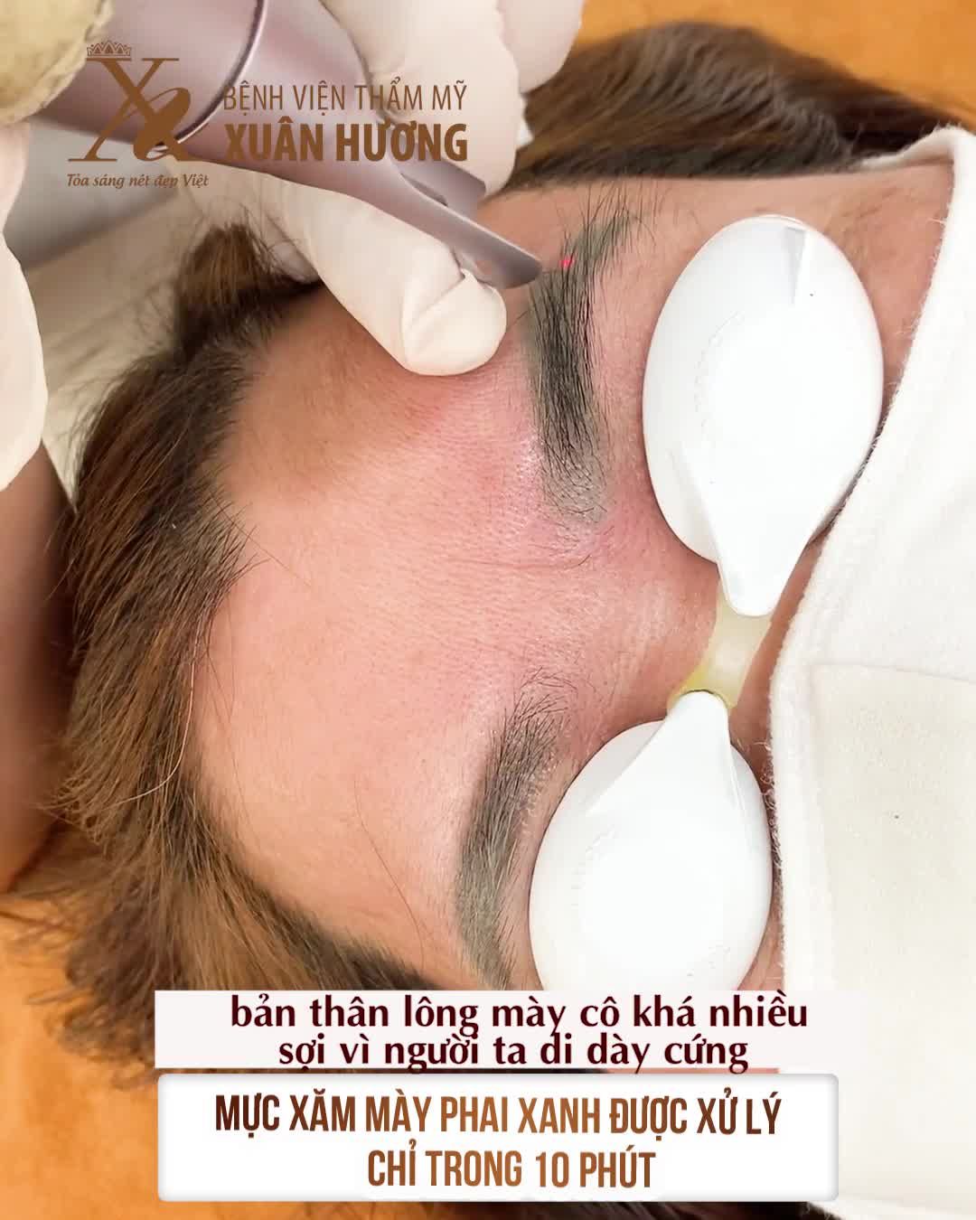 XỬ LÝ NHANH MỰC XĂM MÀY PHAI XANH CHỈ CẦN 1 LẦN