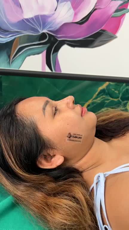Cô gái Việt kiều Pháp chọn Tuấn Linh để nâng mũi...Và kết quả sau 10 ngày tái khám