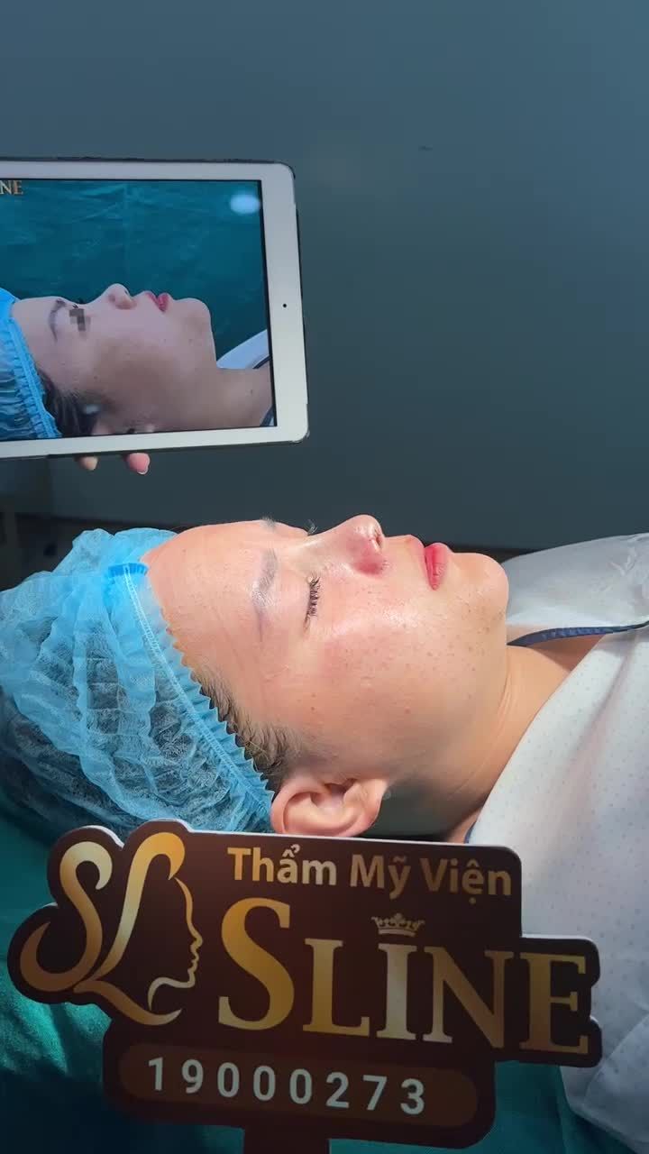KẾT QUẢ CA NÂNG MŨI CẤU TRÚC