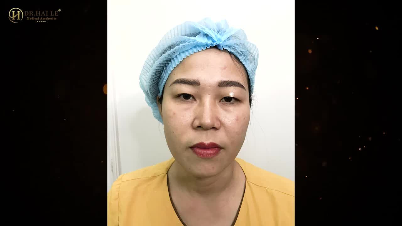 Nhiều khách hàng chia sẻ “Chỉ cần có ý định làm mí thì không cần suy nghĩ mà đến ngay Dr.Hải Lê”