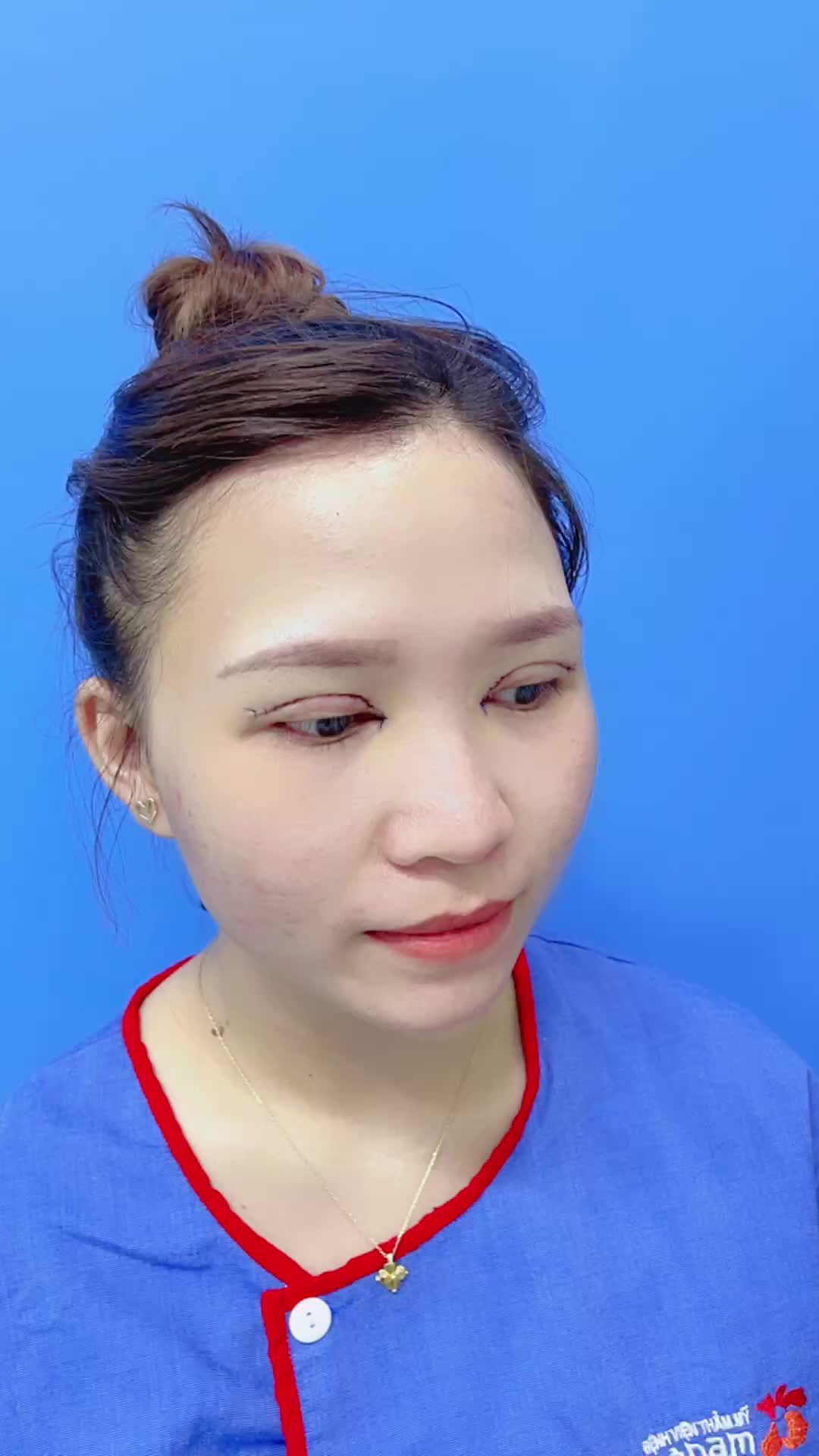Kết quả Cắt mí trên Plasma Plus kết hợp mở khoé mắt trong tại Kangnam