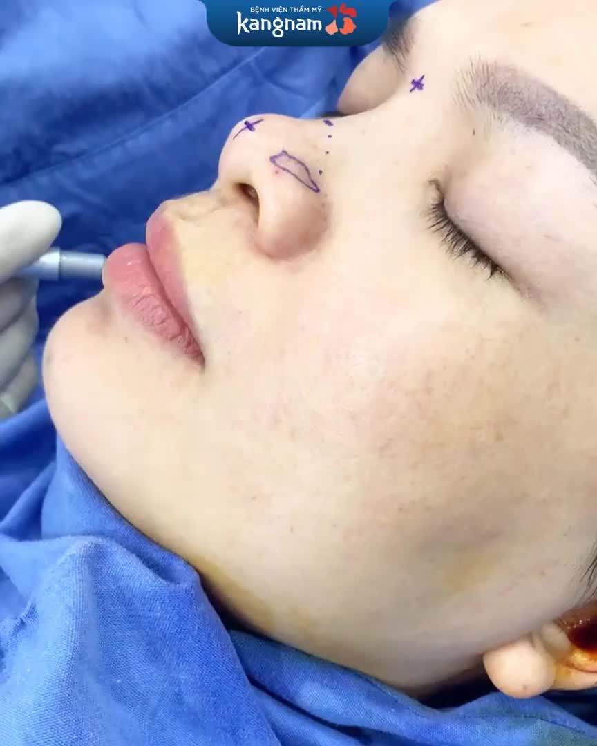 Lên kế hoạch trước phẫu thuật nâng mũi