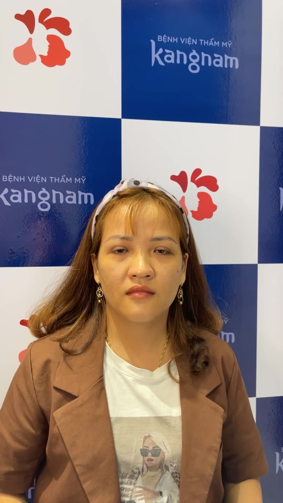 Khách hàng tới BẮT ĐỀN sau 1 tháng cắt mí tại Kangnam