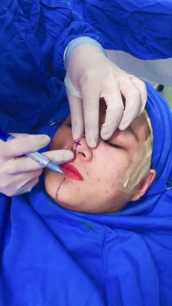 Mất 5 phút để chốt Nâng mũi 6D không đau » Nữ khách hàng bước vào phòng phẫu thuật thực hiện quy trình đo vẽ