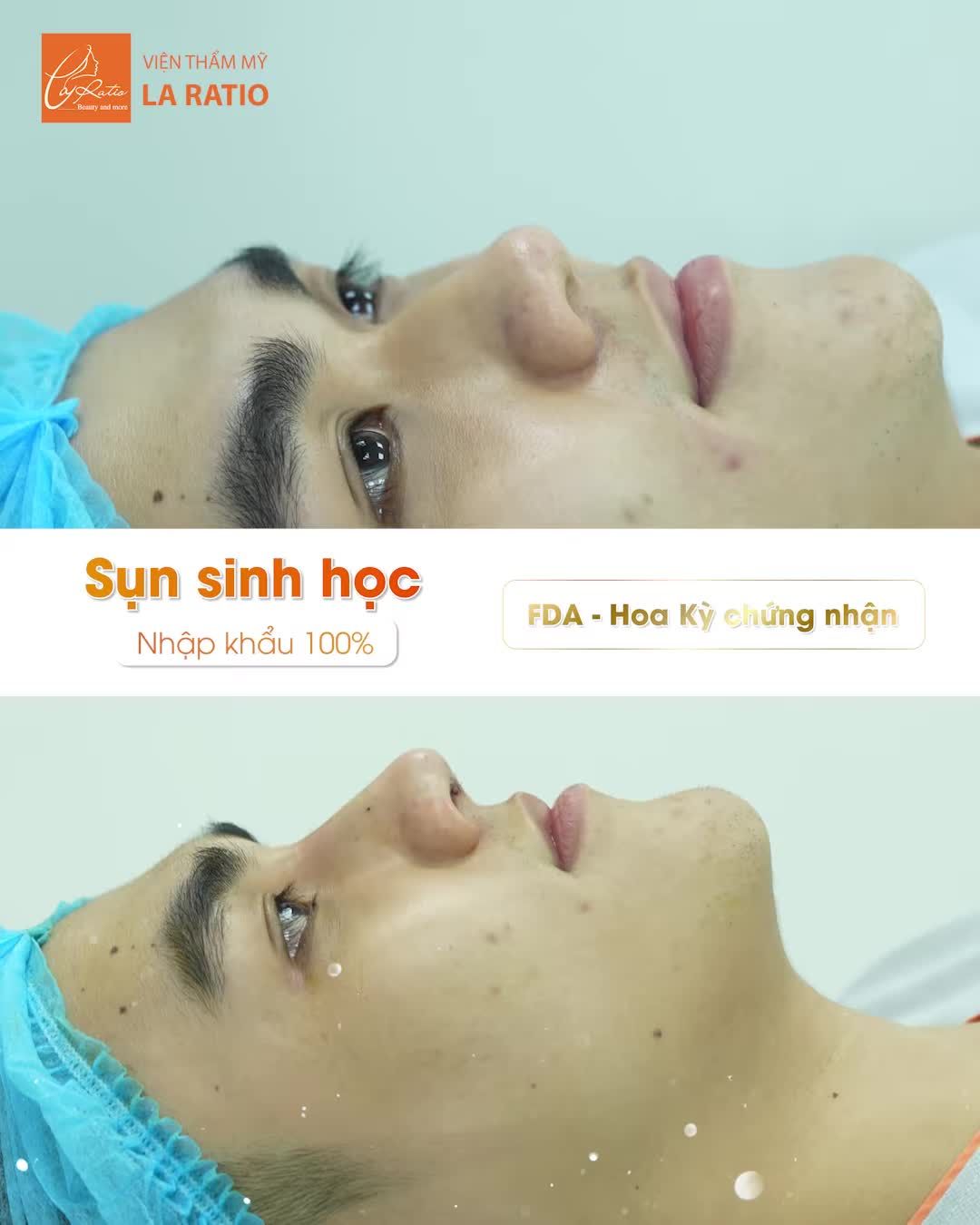 NÂNG MŨI NAM - BIOFORM Chỉ 19tr990 GIÁ CHƯA TỪNG CÓ