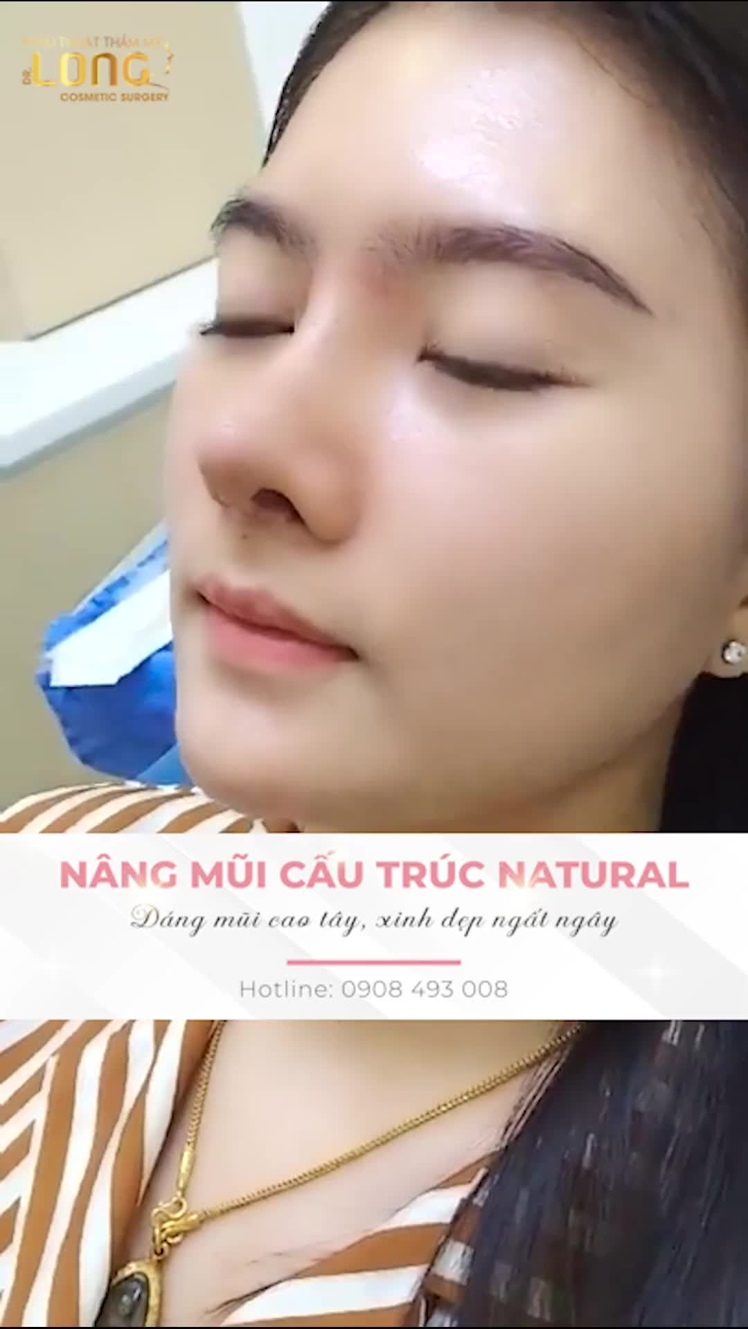 Thực hiện ngay phương pháp nâng mũi để khuôn mặt thanh tú đẹp hơn qua từng ngày.