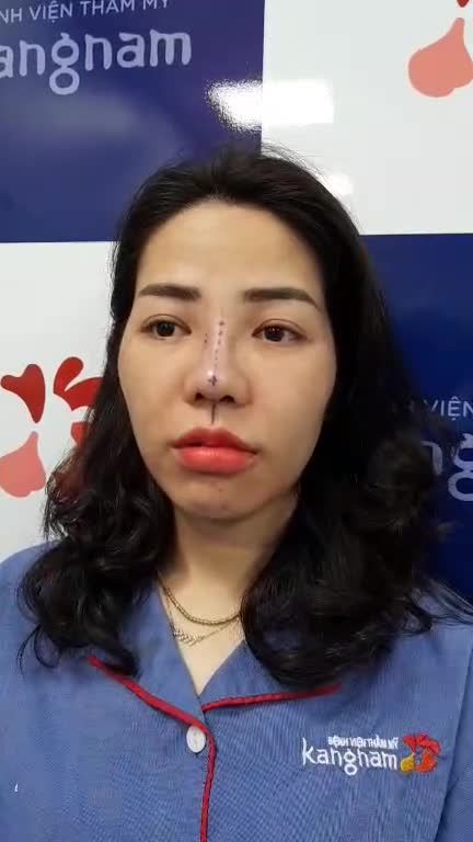 Nâng mũi 6D- surgifrom+ mài gồ, chỉnh xương siêu âm