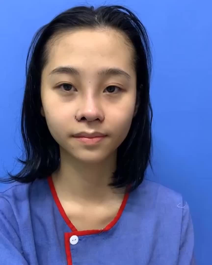 Nâng mũi không đau chút nào